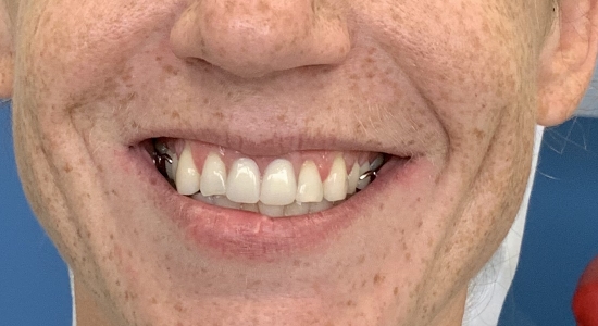 after dentures