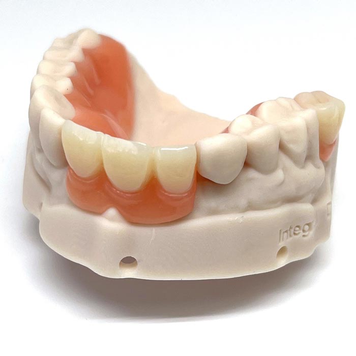 Acrylic Partial Denture in Vancouver, BC