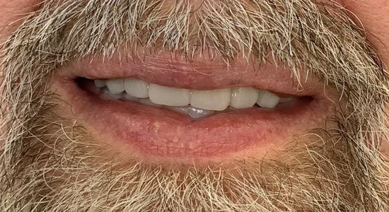 Milled Complete Dentures After