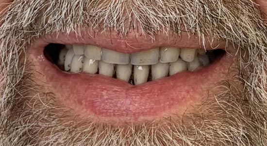 milled complete dentures