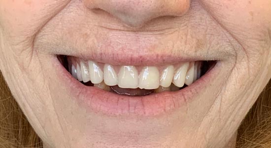 upper denture