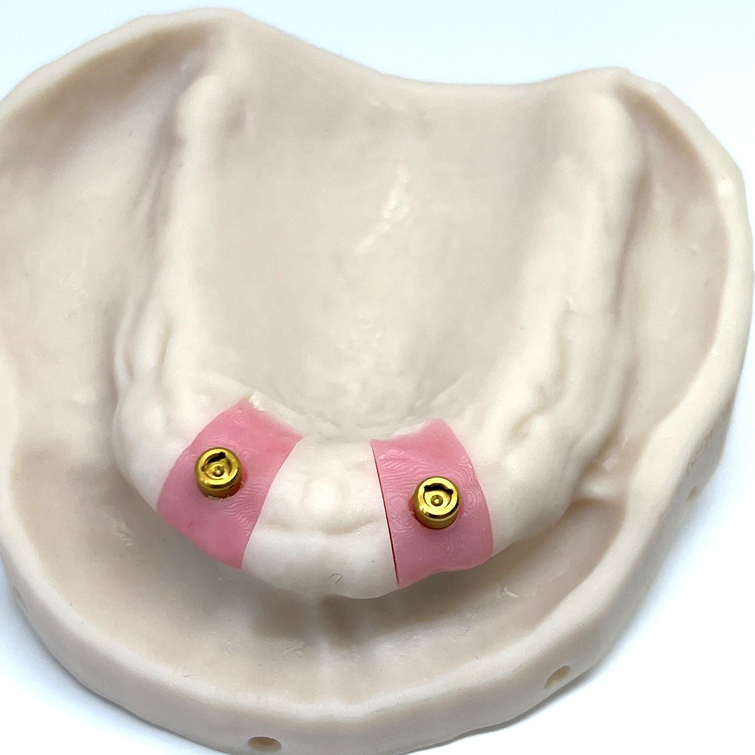 Implant on Dentures